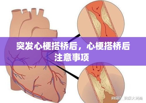 突發(fā)心梗搭橋后，心梗搭橋后注意事項(xiàng) 